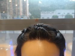 -碧莲盛·不剃发植发