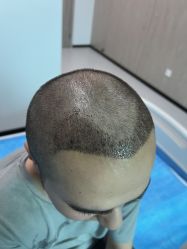 体验后-大麦微针植发全国连锁