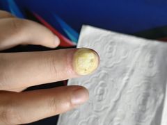 -世龙世家甲沟炎·灰指甲·嵌甲矫正·修脚(武侯区双楠店)