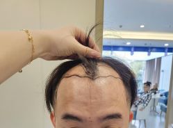 -大麦微针植发全国连锁