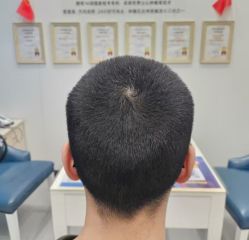 -大麦微针植发全国连锁