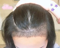 -大麦微针植发丨全国连锁