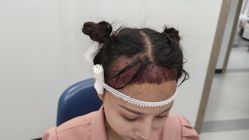 -大麦微针植发全国连锁