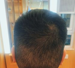 -大麦微针植发全国连锁
