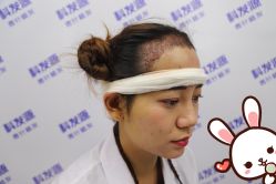 -大麦微针植发丨全国连锁