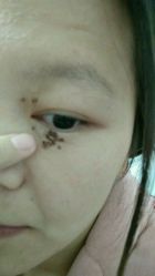 第4天掉了些痂-美丽人生祛斑扁平疣汗管瘤中心