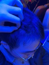 -碧莲盛·不剃发植发