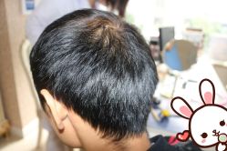 点击看大图 -大麦微针植发丨全国连锁