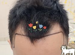 -大麦微针植发全国连锁