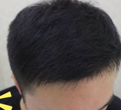 -大麦微针植发丨全国连锁