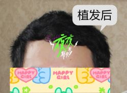 -大麦微针植发全国连锁
