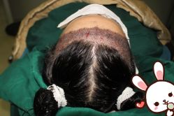 点击看大图 -大麦微针植发丨全国连锁