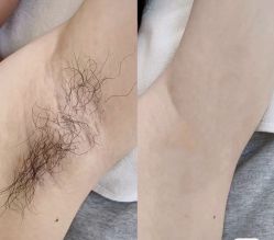 -薇兰专业脱毛连锁机构