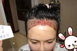 -大麦微针植发丨全国连锁