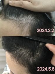 -菩叶脱发白发中心