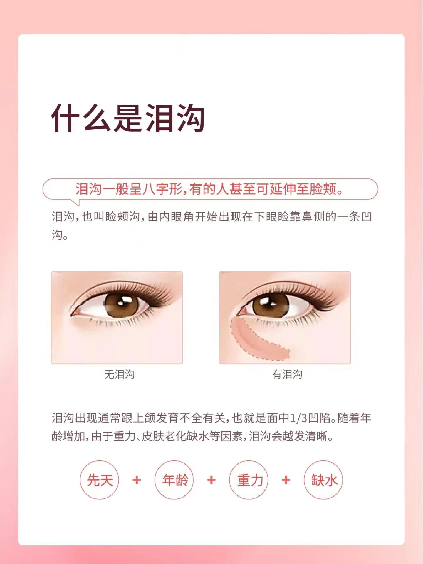 泪沟科普之你知泪沟是什么吗?又该怎么去改善它