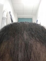 点击看大图 -大麦微针植发丨全国连锁