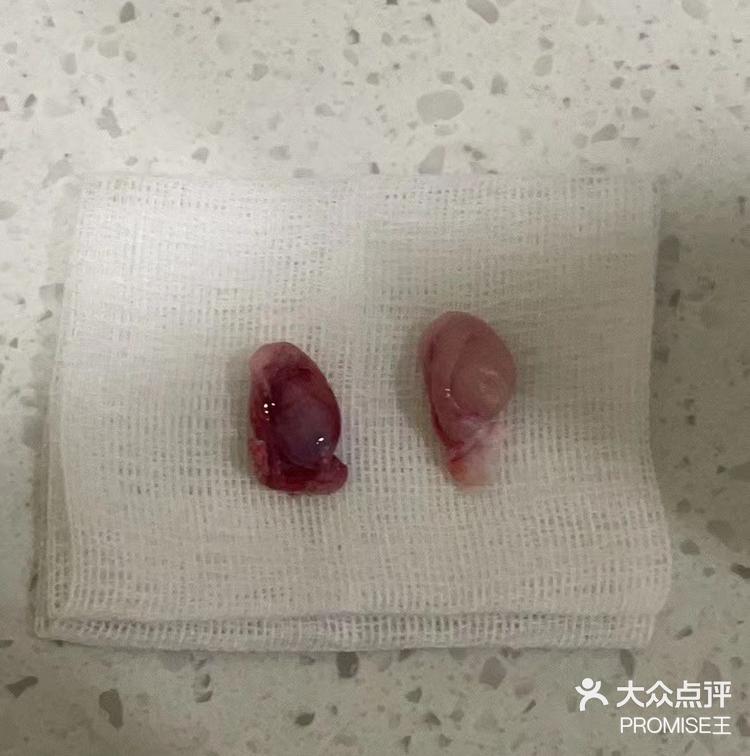 蛋,蔡医生检查发现只有一个,做了超声还有一个在肚子里,蔡医生手术做