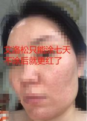 体验后-伊丽莎白医疗美容