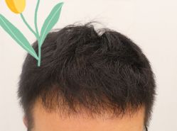 -大麦微针植发全国连锁