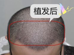 -大麦微针植发全国连锁