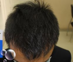 -大麦微针植发丨全国连锁