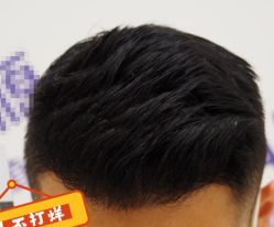 -大麦微针植发全国连锁