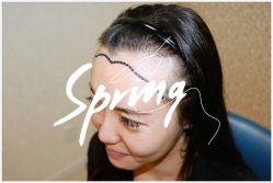 点击看大图 体验后-大麦微针植发全国连锁