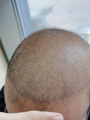 -碧莲盛·不剃发植发