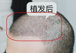 -大麦微针植发全国连锁