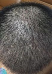 -大麦微针植发丨全国连锁