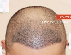 -大麦微针植发全国连锁