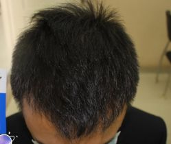 -大麦微针植发丨全国连锁