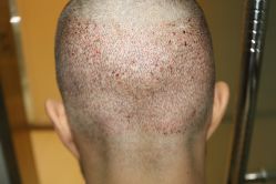 -大麦微针植发丨全国连锁