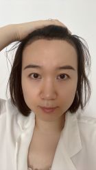 -大麦微针植发丨全国连锁