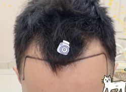 -大麦微针植发全国连锁