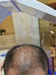 -碧莲盛·不剃发植发