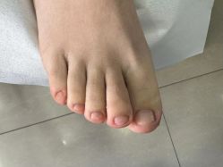 -德哥灰指甲脚气甲沟炎跖疣护理