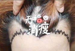 -大麦微针植发全国连锁