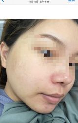 体验后-颜蕾医美黄金微针水光美肤玻尿酸抗衰中心