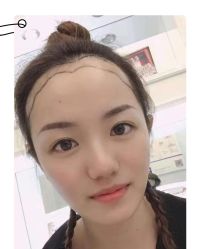 -大麦微针植发全国连锁