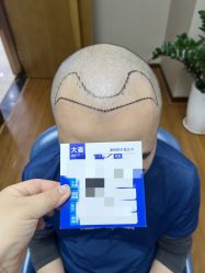 体验前-大麦微针植发全国连锁