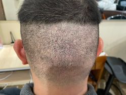 -碧莲盛·不剃发植发