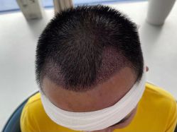 点击看大图 体验后-大麦微针植发全国连锁