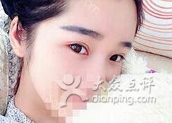 点击看大图 双眼皮-希思特医疗美容医院