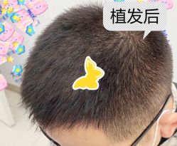 -大麦微针植发全国连锁