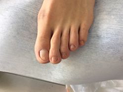 -德哥灰指甲脚气甲沟炎跖疣护理