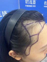 -碧莲盛不剃发植发