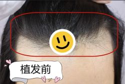 -大麦微针植发全国连锁