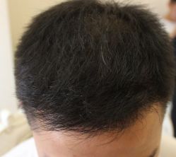 -大麦微针植发丨全国连锁